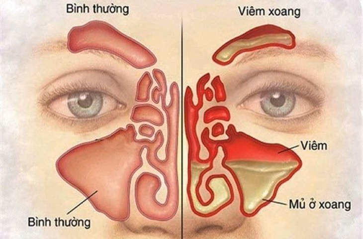 Hình ảnh nội soi mũi xoang phát hiện niêm mạc phù nề và dịch mủ nhầy bít tắc khe giữa