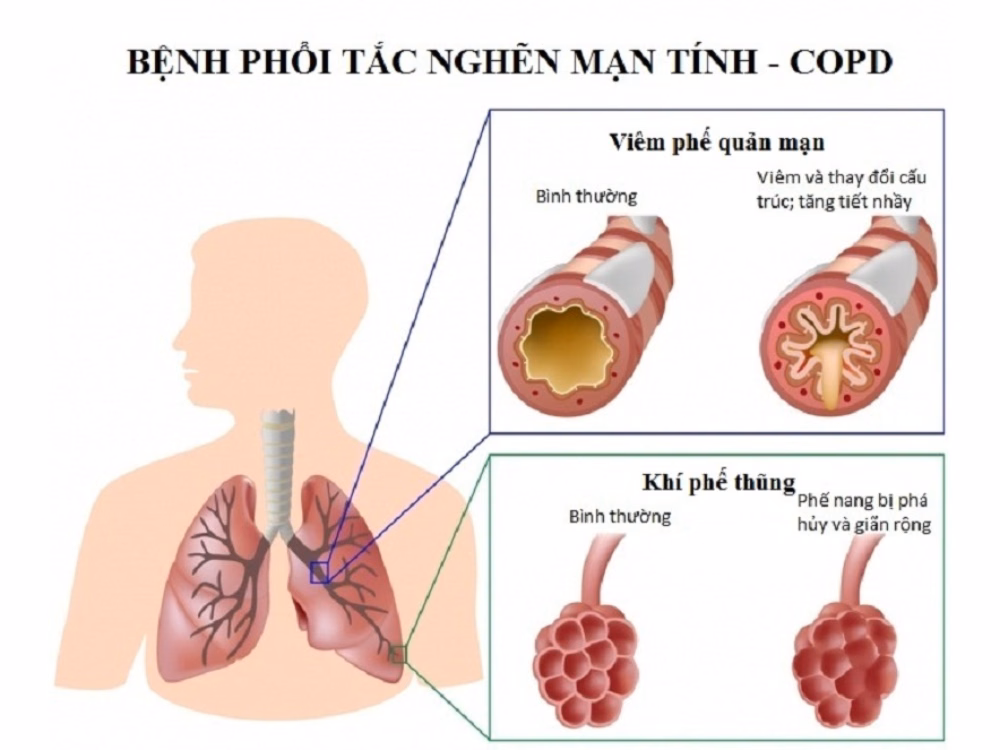 Người bệnh phổi tắc nghẽn mạn tính sử dụng bình xịt định liều đúng kỹ thuật tại nhà