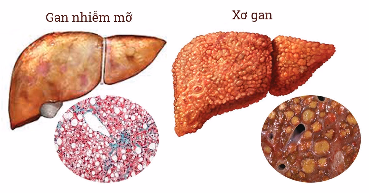 Bác sĩ chuyên khoa thực hiện siêu âm vùng hạ sườn phải để đánh giá cấu trúc và đo kích thước gan