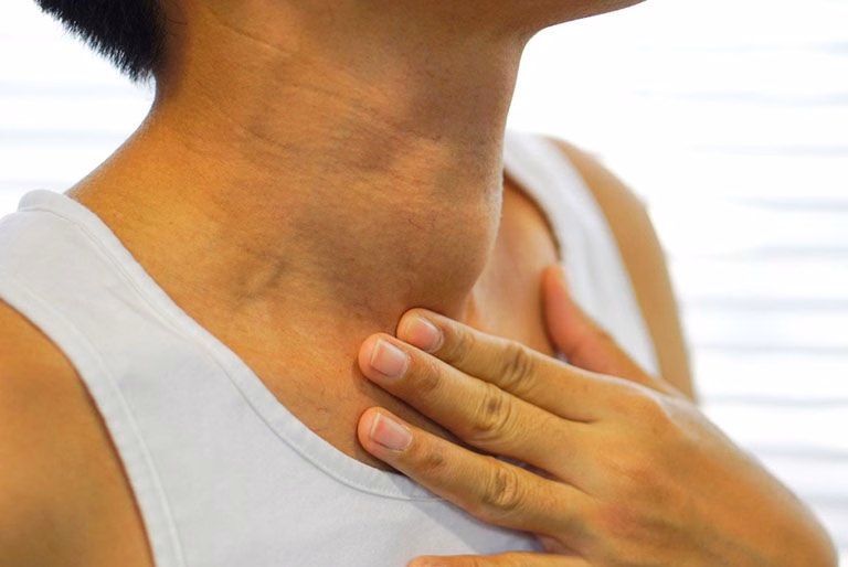 Người bệnh tự nhận thấy vùng cổ trước sưng to do bướu giáp keo