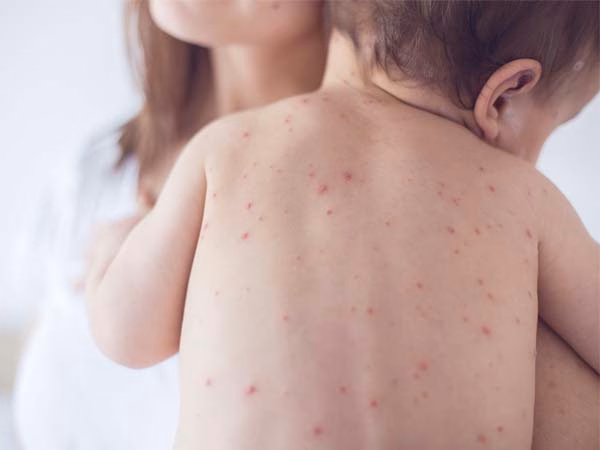 Theo dõi y tế và chăm sóc hỗ trợ người bệnh sốt xuất huyết Dengue tại cơ sở y tế