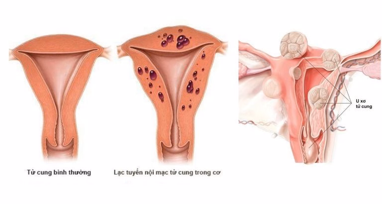Biểu hiện chảy máu kinh nguyệt lượng nhiều bất thường hoặc kéo dài gây mệt mỏi ở nữ giới