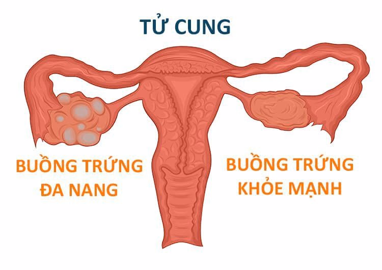 Sơ đồ giải phẫu so sánh cấu trúc buồng trứng đa nang với buồng trứng khỏe mạnh bình thường