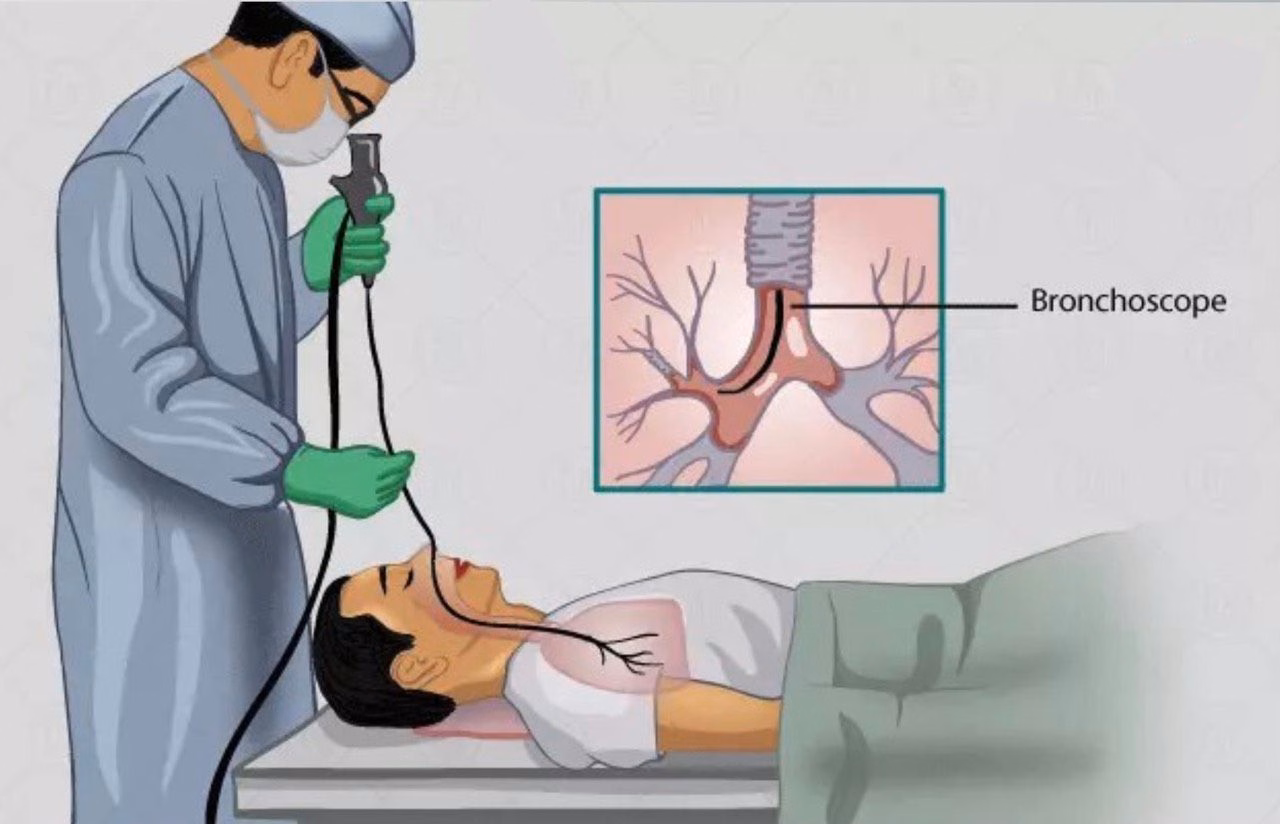 Bác sĩ tiến hành nội soi phế quản và rửa phế quản phế nang để chẩn đoán xuất huyết phổi