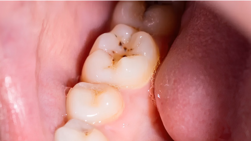Khám và kiểm tra răng miệng trước khi đi Nhật Bản