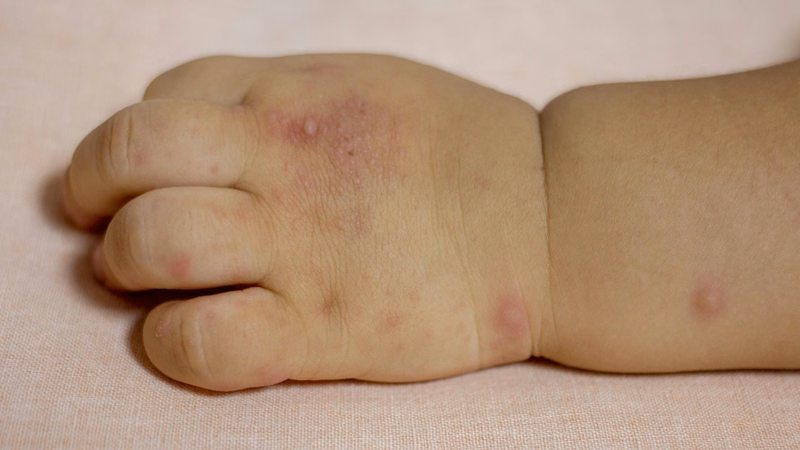Biến thể C1 chủng virus EV71 gây bệnh tay chân miệng với độc lực cao và nguy cơ né miễn dịch ở trẻ em