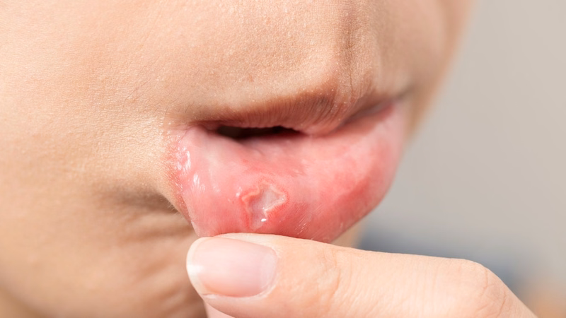 Vết loét trong khoang miệng của trẻ mắc bệnh tay chân miệng gây đau rát