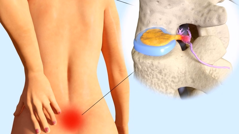 Bác sĩ tư vấn phương pháp điều trị thoát vị đĩa đệm L4 L5 cho người bệnh