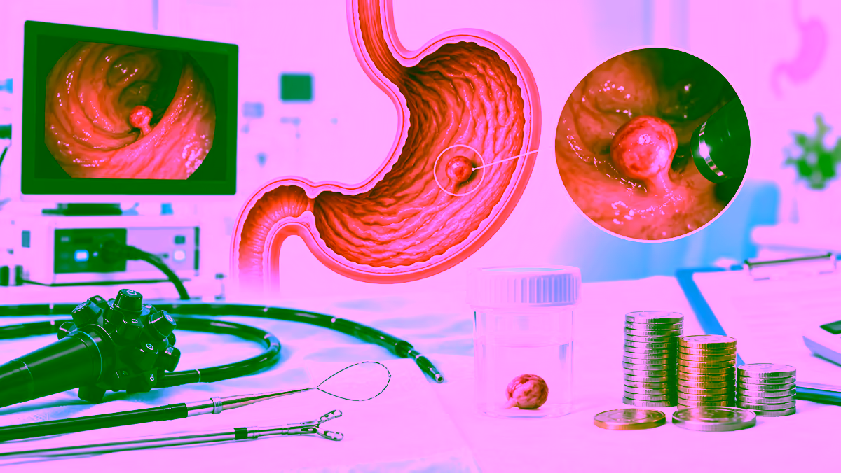Sơ đồ polyp dạ dày qua nội soi và dụng cụ cắt polyp