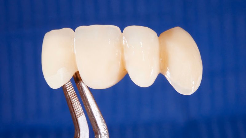 Mô hình cấu trúc phục hình cầu răng sứ thay thế răng đã mất