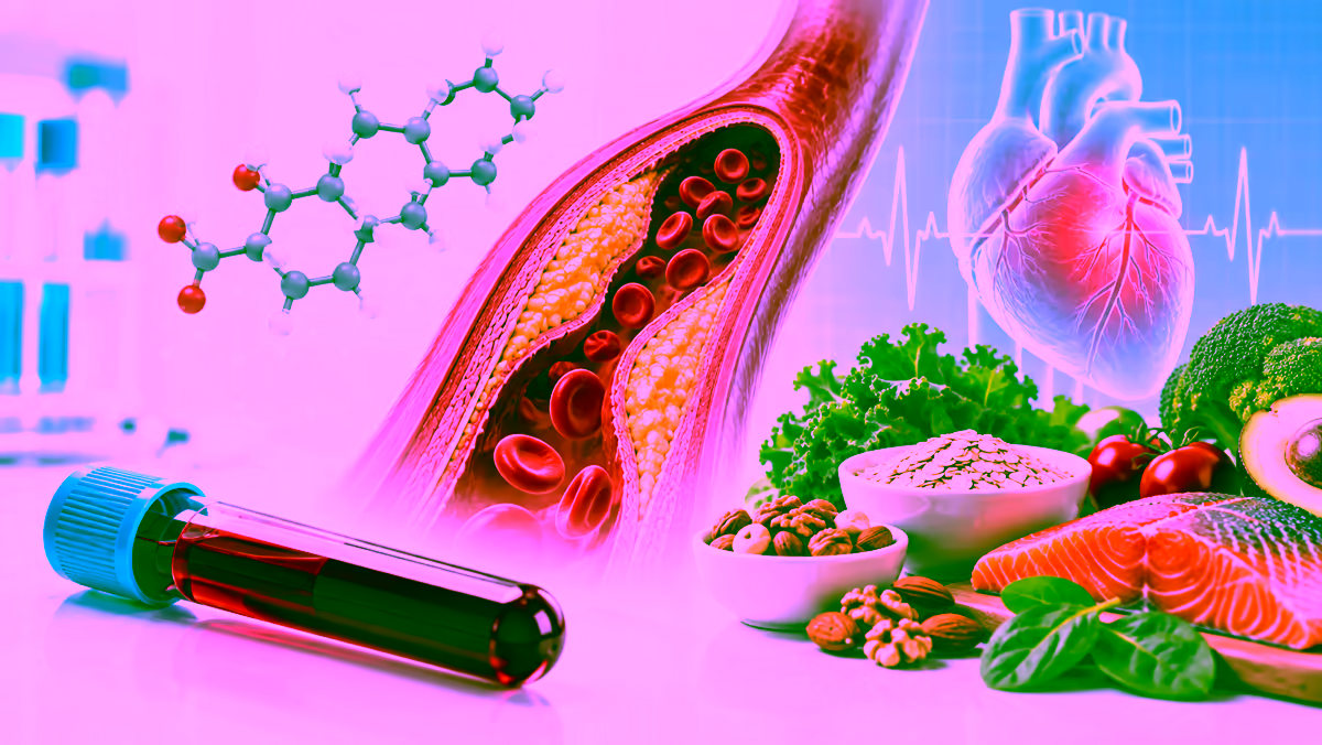 Minh họa cholesterol cao và mảng bám trong động mạch