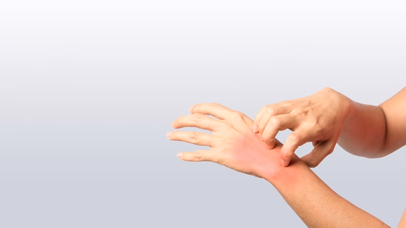 Hình ảnh hướng dẫn chườm mát giảm ngứa và sưng đỏ da do dị ứng thức ăn