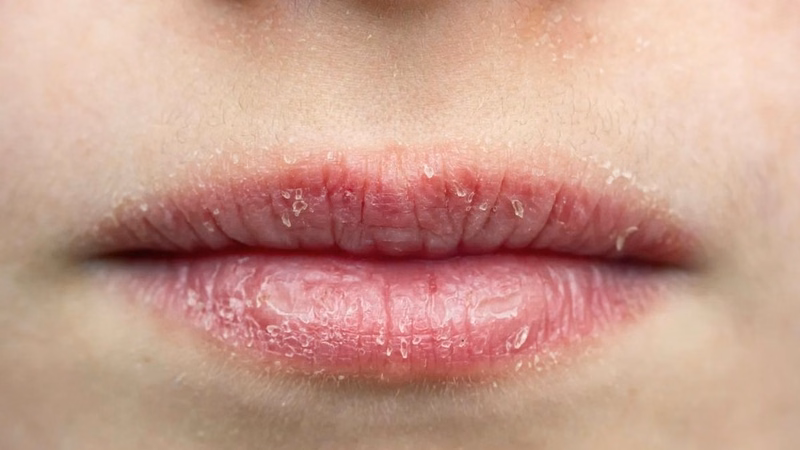 Tình trạng viền môi khô rát, bong tróc nứt nẻ do thiếu độ ẩm và tác động từ môi trường