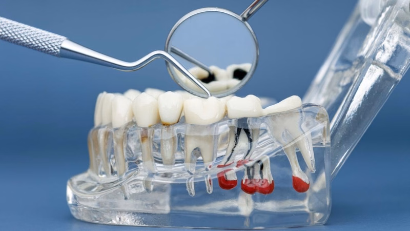 Người bệnh tìm hiểu chi phí lấy tủy răng số 7 bao nhiêu tiền trước khi thực hiện điều trị nội nha