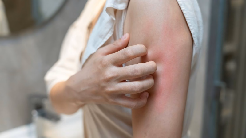 Biện pháp chăm sóc và dưỡng ẩm làm dịu vùng da bị mẩn ngứa