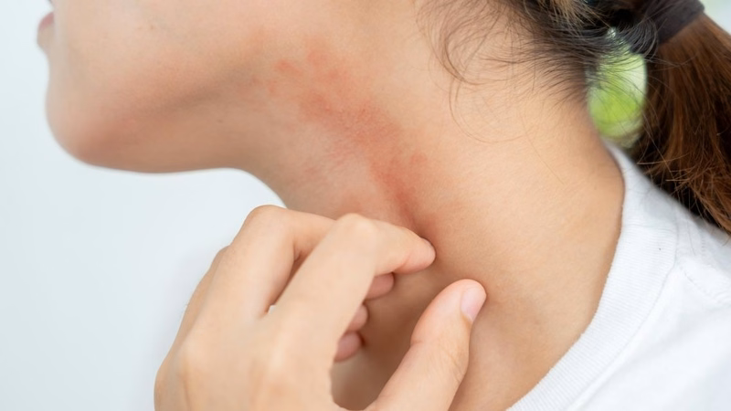 Tình trạng nổi mẩn ngứa mẩn đỏ rải rác trên da toàn thân