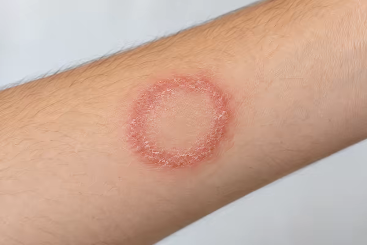 Hình minh họa tổn thương nấm da Dermatophytosis dạng vòng ở cẳng tay