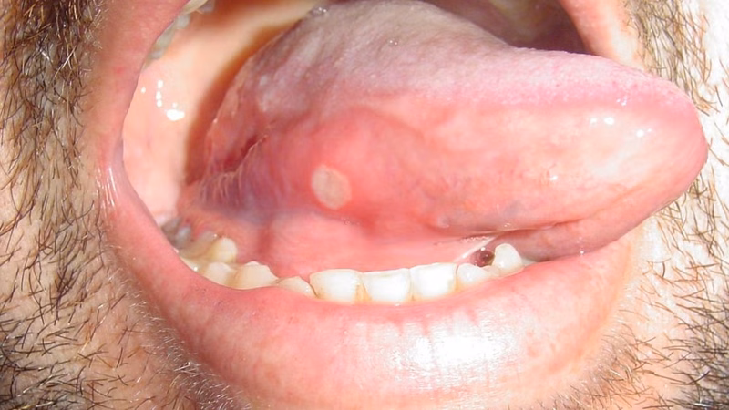 Vết loét nhiệt miệng dưới lưỡi gây đau rát khi ăn uống và giao tiếp