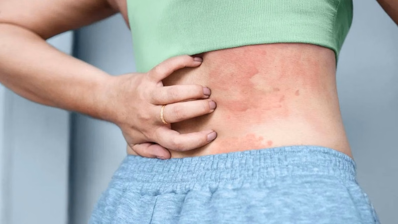 Hình ảnh mề đay cấp tính thuyên giảm sau khi loại bỏ tác nhân kích ứng