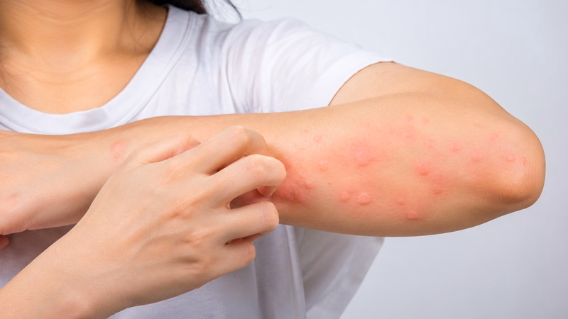 Mảng sẩn phù đỏ ngứa rát xuất hiện trên vùng da hở