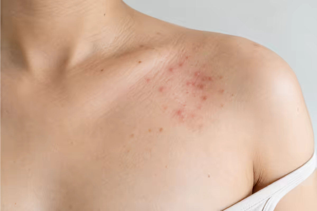 Cận cảnh vùng da thân trên có các nốt phát ban keto