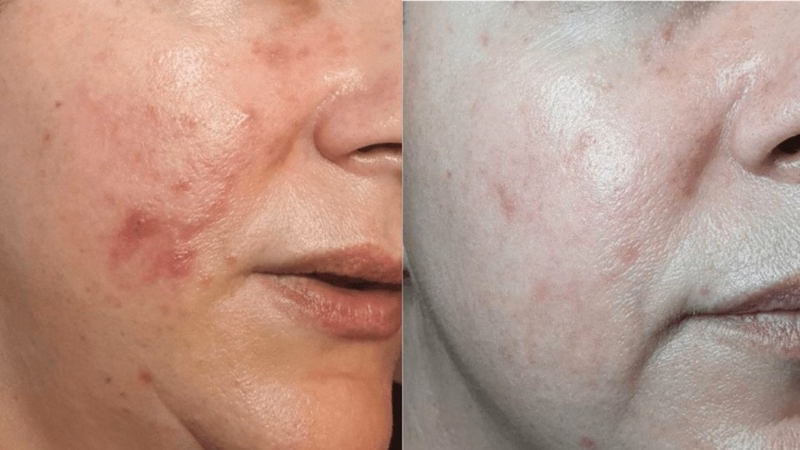 Thiết bị phát plasma lạnh nhiệt độ thấp an toàn cho mô sinh học
