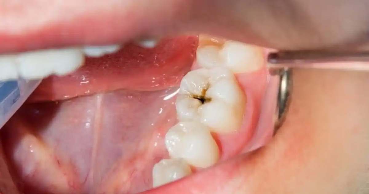 Nhổ răng cấm có đau không và các trường hợp tạm hoãn cần lưu ý