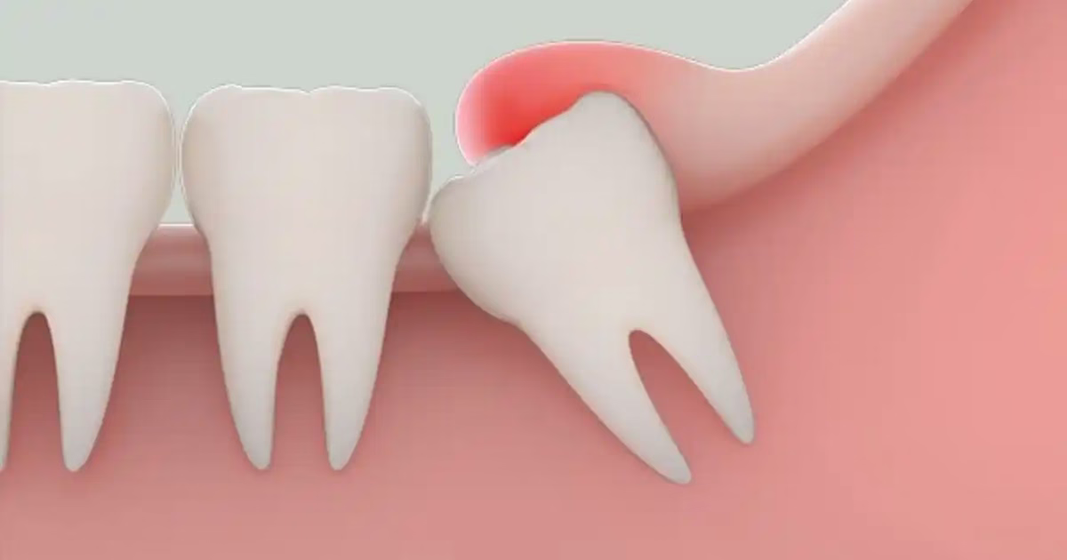 Tại sao gọi là răng khôn và lý do phần lớn răng khôn phải nhổ bỏ