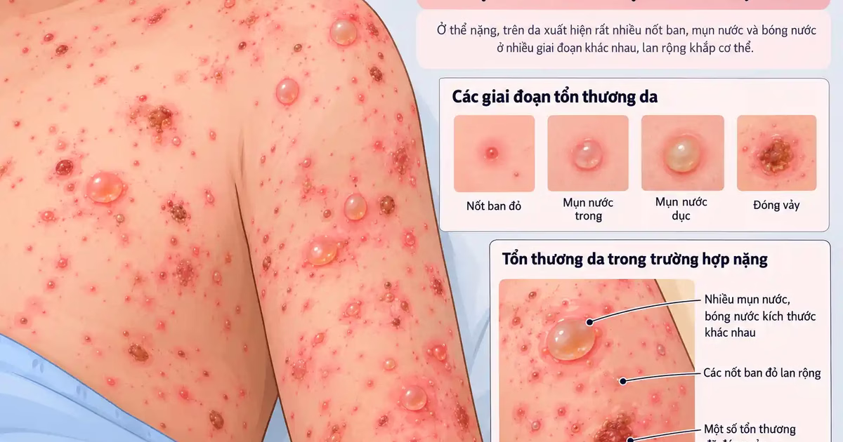 Bệnh thủy đậu nặng và các biến chứng nguy hiểm cần phòng ngừa