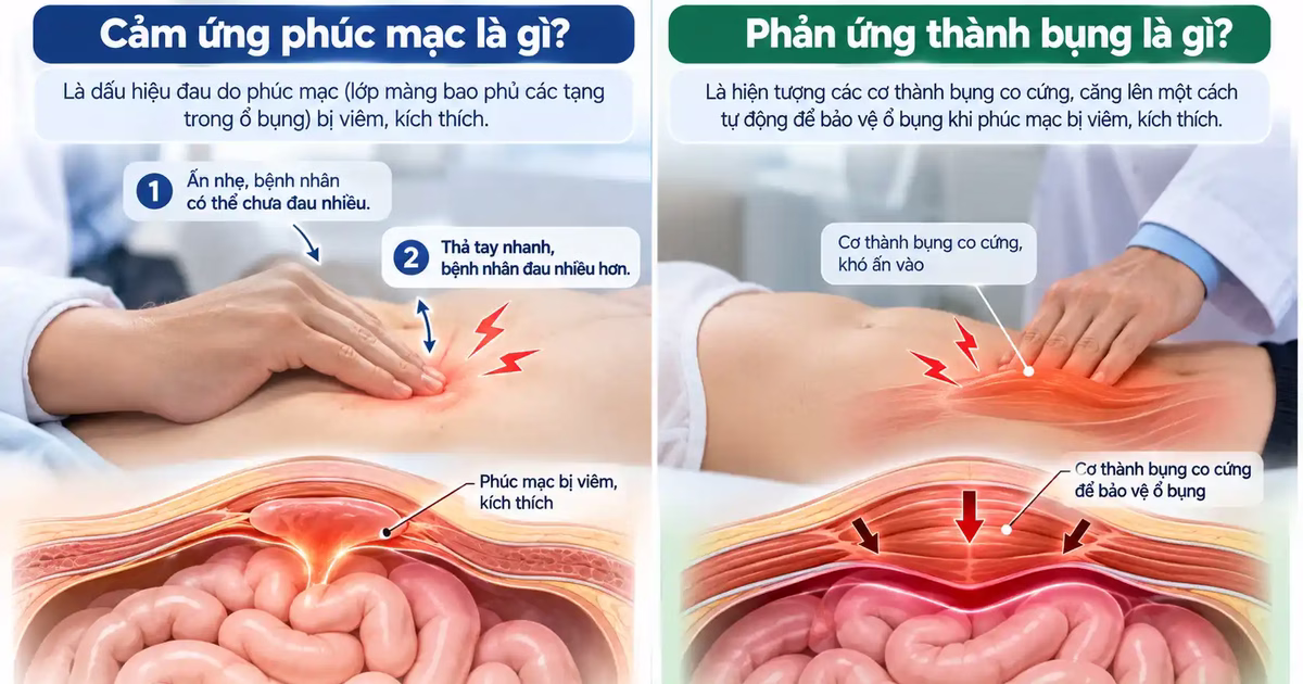 Cảm ứng phúc mạc và phản ứng thành bụng là gì