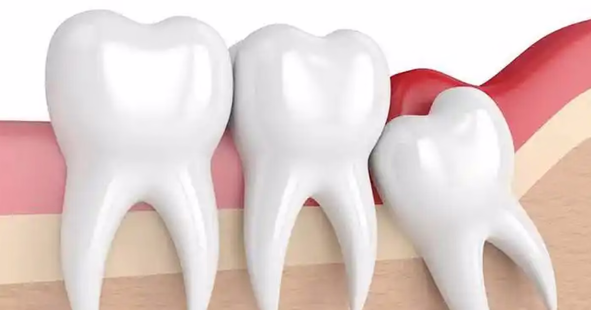 Răng số 8 mọc lệch có nguy hiểm không và khi nào cần can thiệp