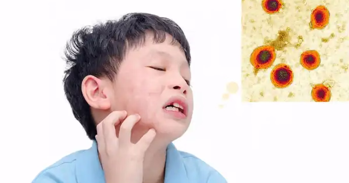 Bị quai bị lúc nhỏ có ảnh hưởng gì tới sức khỏe sau này không?