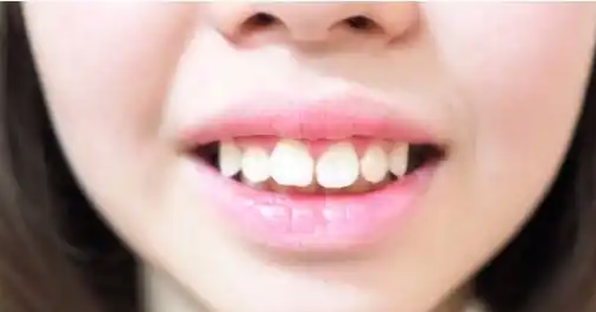 Răng hô vẩu: Nguyên nhân hình thành và các phương pháp cải thiện