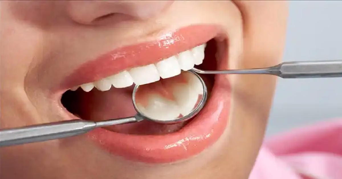 Hàn răng thưa bằng composite có nguy hiểm không và những lưu ý cần biết