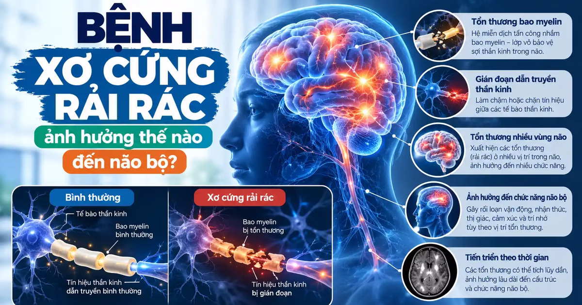 Bệnh xơ cứng rải rác ảnh hưởng thế nào đến não bộ