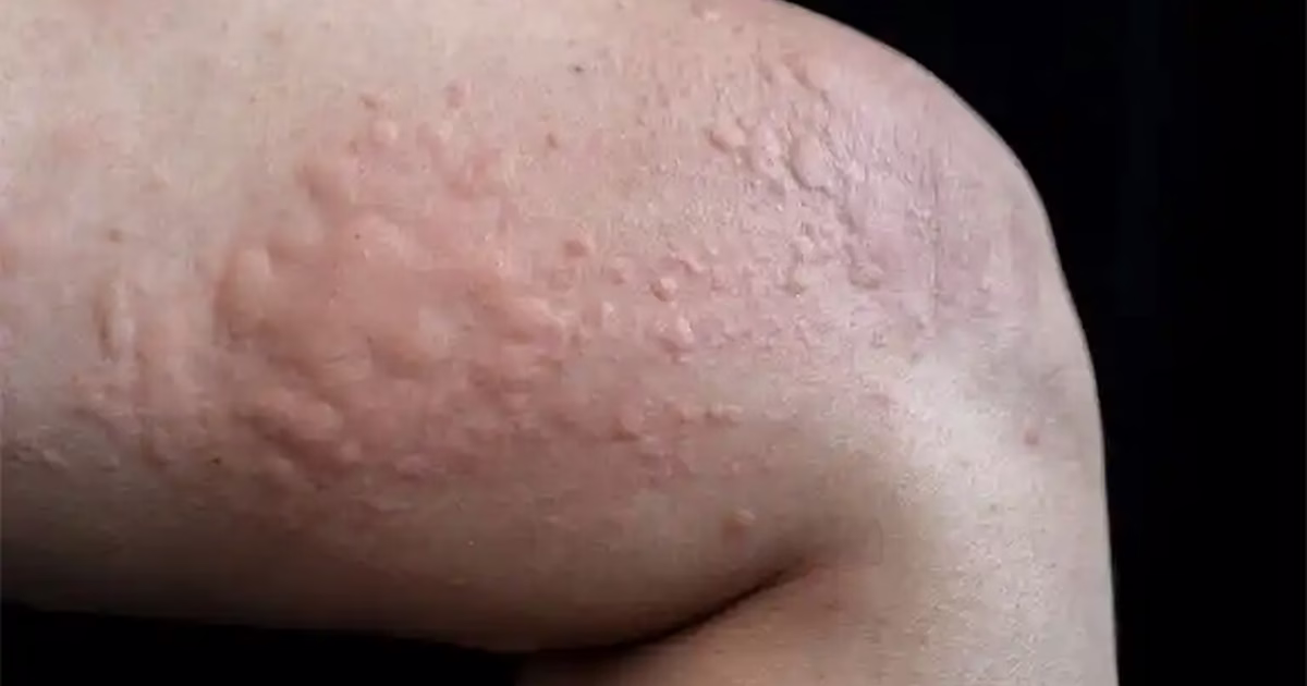 Cách giảm ngứa khi bị dị ứng an toàn và hiệu quả tại nhà