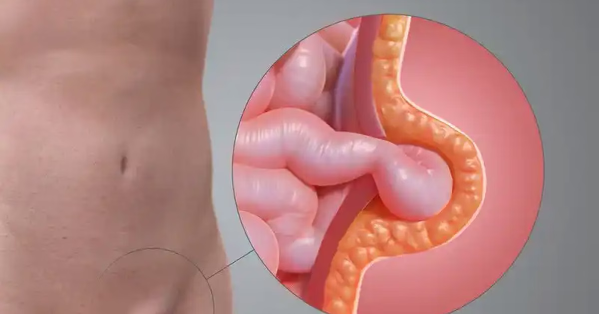 Thoát vị bẹn có nguy hiểm không và những thông tin cần biết