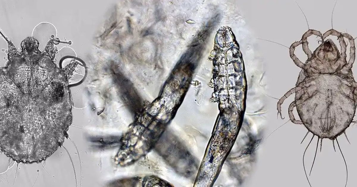 Ý nghĩa của xét nghiệm Demodex soi tươi trong chẩn đoán bệnh da liễu
