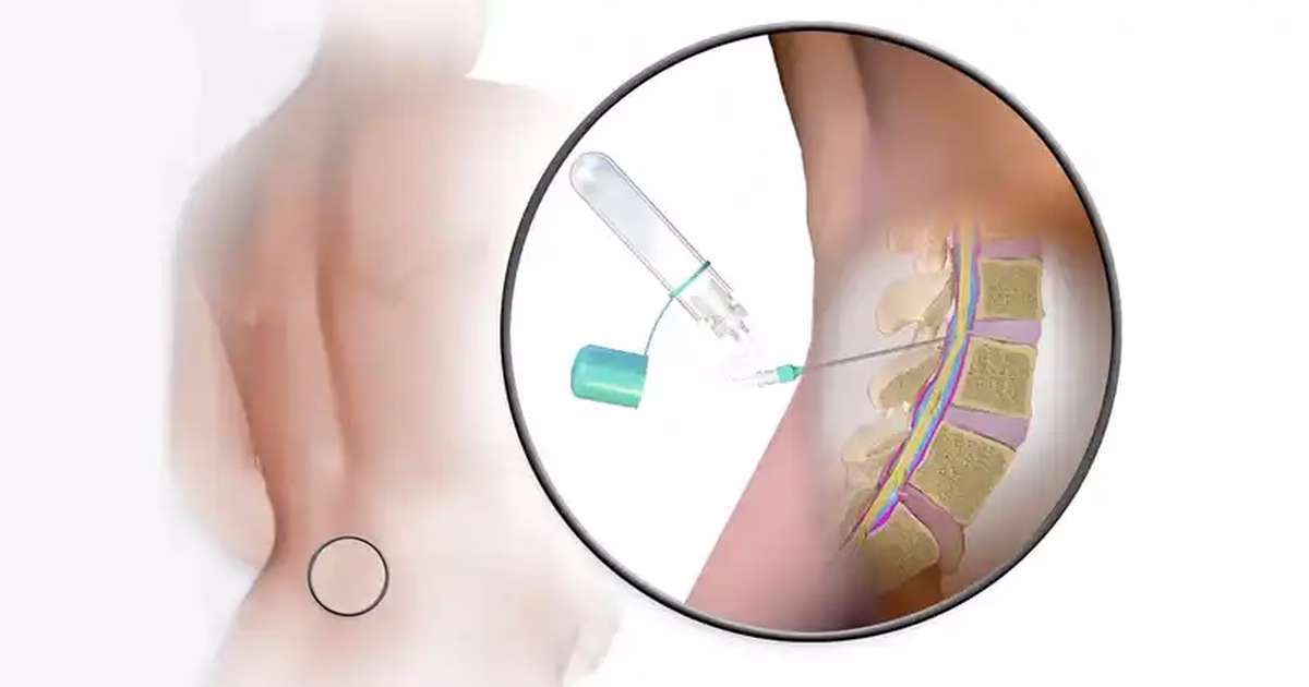 Viêm não tủy hậu nhiễm: Nguyên nhân, yếu tố kích hoạt và phương pháp chẩn đoán