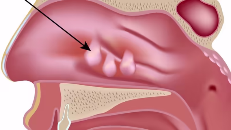 Hình minh họa các polyp trong hốc mũi