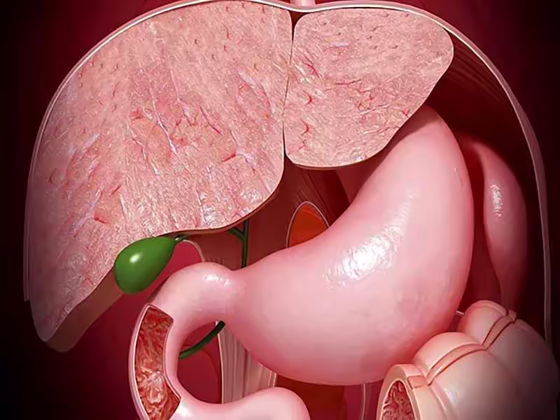 Hình minh họa vị trí túi mật và tổn thương polyp trong hệ gan mật