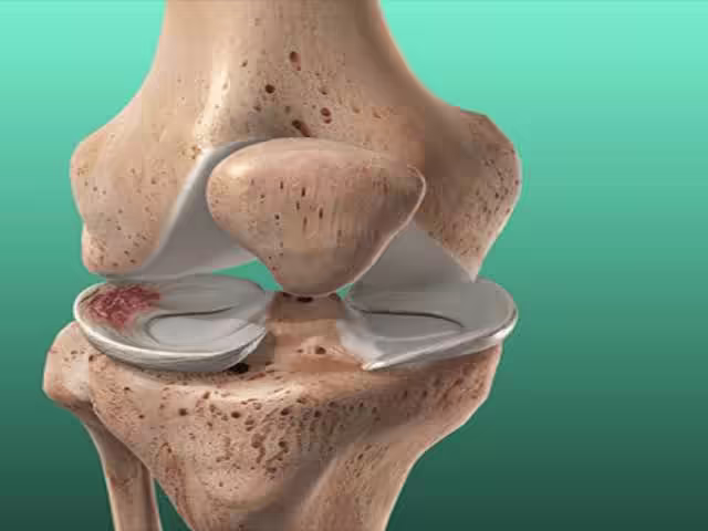 Mô hình khớp gối minh họa vùng rách sụn chêm