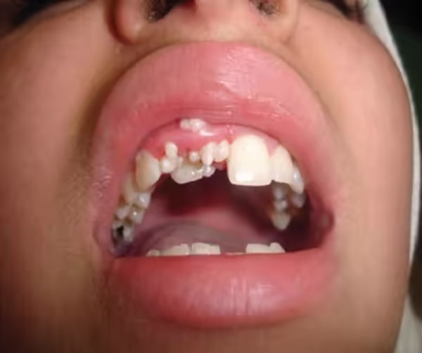 Hình ảnh răng thừa mọc chen lấn trên cung hàm