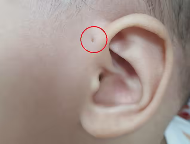 Lỗ rò luân nhĩ nhỏ phía trước vành tai ở trẻ