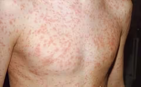 Ban dát đỏ lan trên da, biểu hiện thường gặp của Rubella
