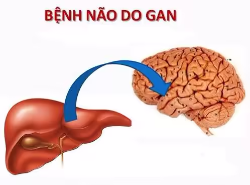 Minh họa mối liên hệ giữa bệnh gan và ảnh hưởng đến não