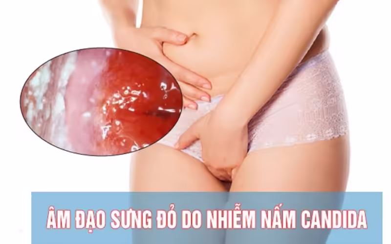 Người bệnh khó chịu vùng kín với hình minh họa niêm mạc viêm do nấm Candida