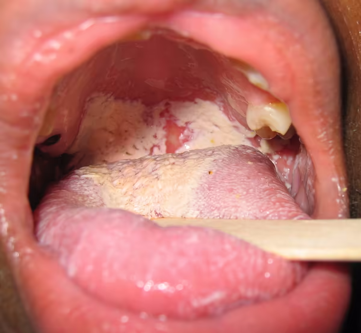 Mảng trắng ở niêm mạc miệng và lưỡi trong bệnh nấm miệng