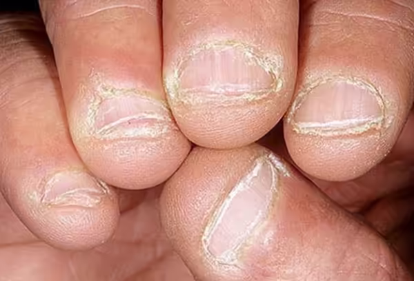 Móng tay dày, giòn và bong vảy gợi ý nhiễm nấm
