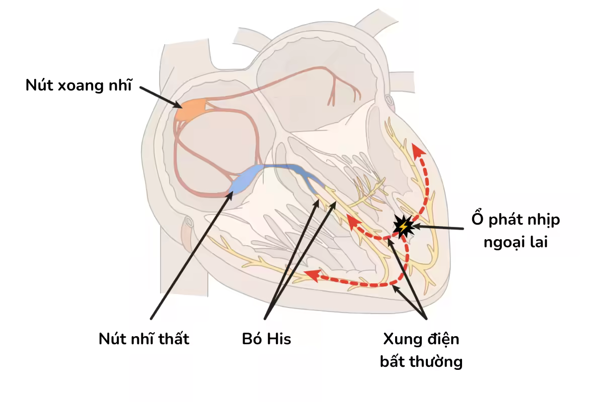 Sơ đồ tim minh họa ổ phát nhịp ngoại lai và xung điện bất thường